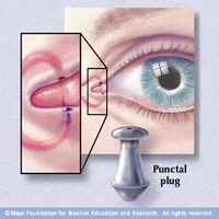 Puntal-Plugs